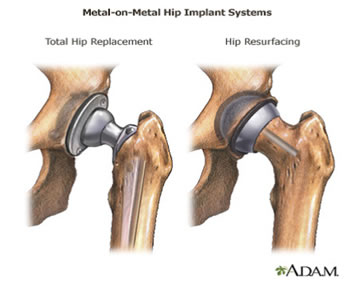 Metal On Hip Implant