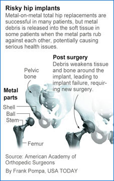 hip replacement surgery